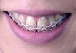 braces-palepink2