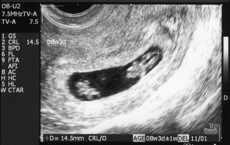 妊娠８週 双子判明 ちーぼうの ななと双子 育児日記 楽天ブログ