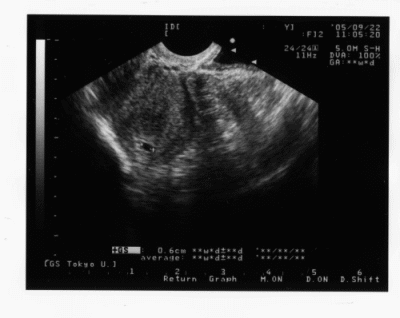 胎嚢 6 のみ 週