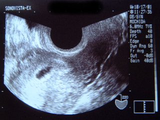見え 7 ない 胎芽 週